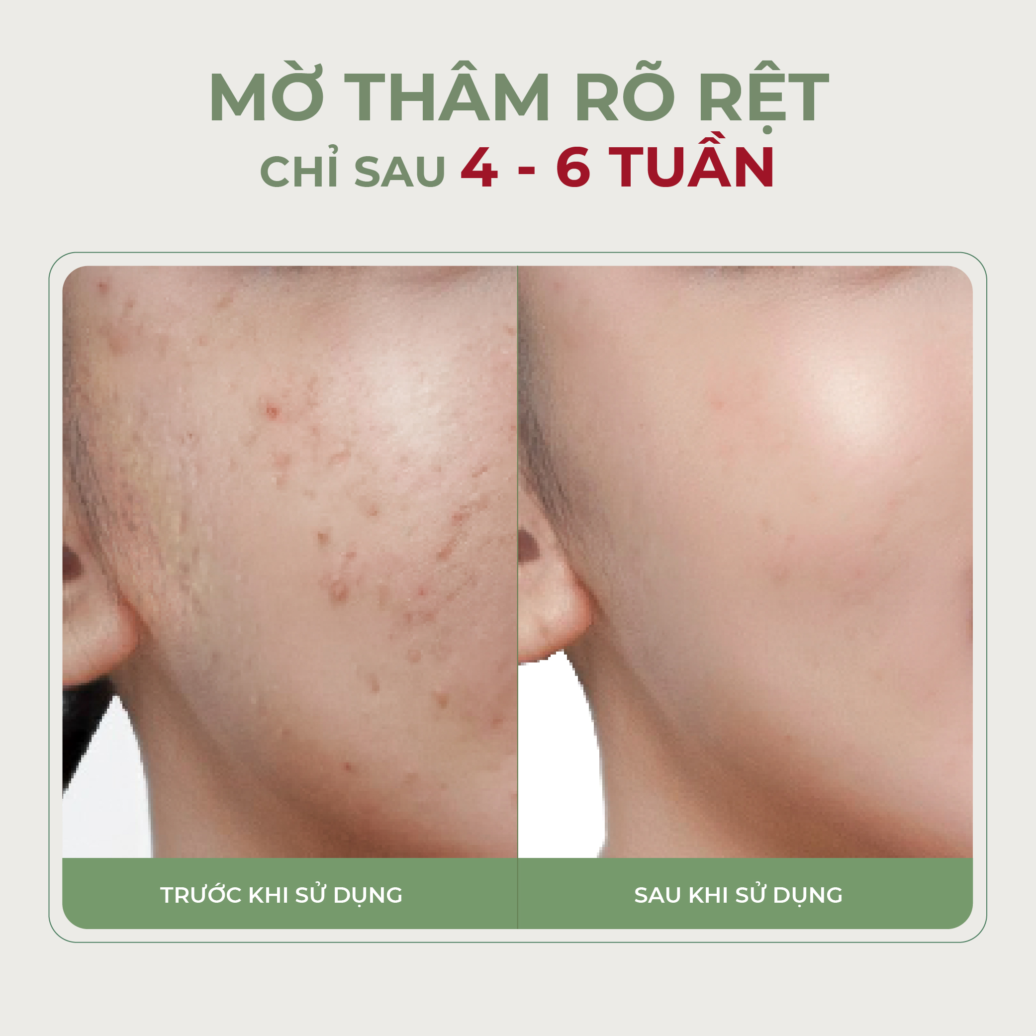 Serum Nghệ Đỏ Nano Abera - 15ML Làm Mờ Thâm Mụn, Thâm Quầng Mắt , Tinh Chất Dưỡng Trắng Da