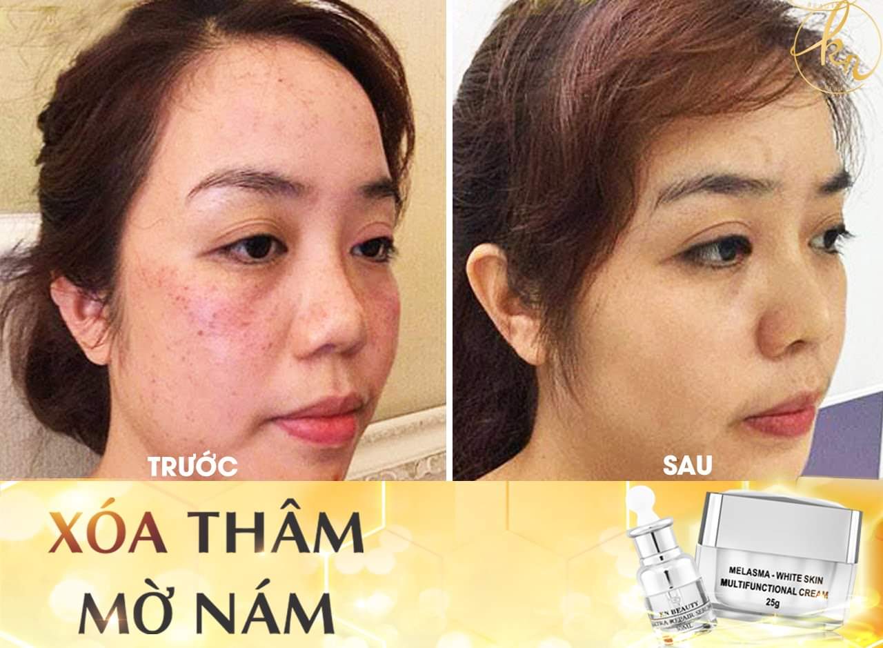 Bộ 2 sản phẩm Xóa Mờ Thâm Nám, Tàn Nhang, Đồi Mồi, Làm Trắng Da, Chống Nắng KN Beauty chuyên sâu : Kem dưỡng 25g + Serum 30ml