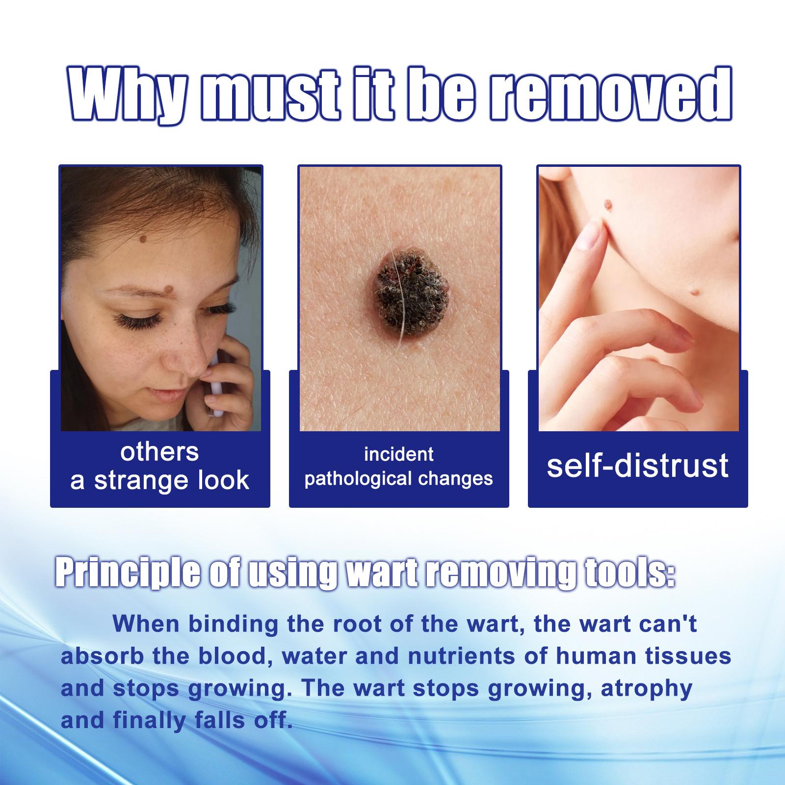 South Moon 30pcs/Box Mole Wart Remover Skin Tag Rubber Band Soften Keratin Painless Removal