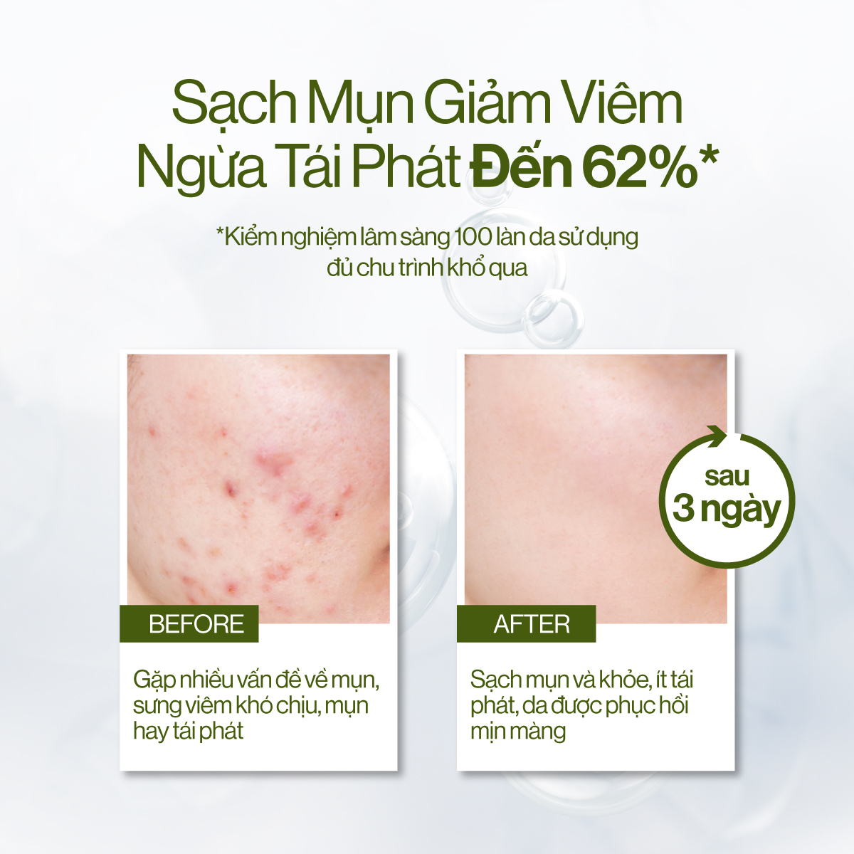 Kem Dưỡng Khổ Qua + B5 Gilaa Blemish Repair giúp Phục Hồi Giảm Mụn 50ml