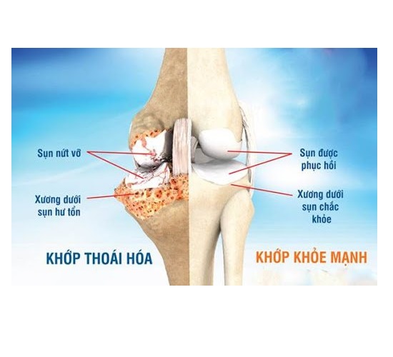 Viên Khớp TPN Plus hỗ trợ tăng khả năng hồi phục khớp, giúp giảm nguy cơ thoái hóa khớp.