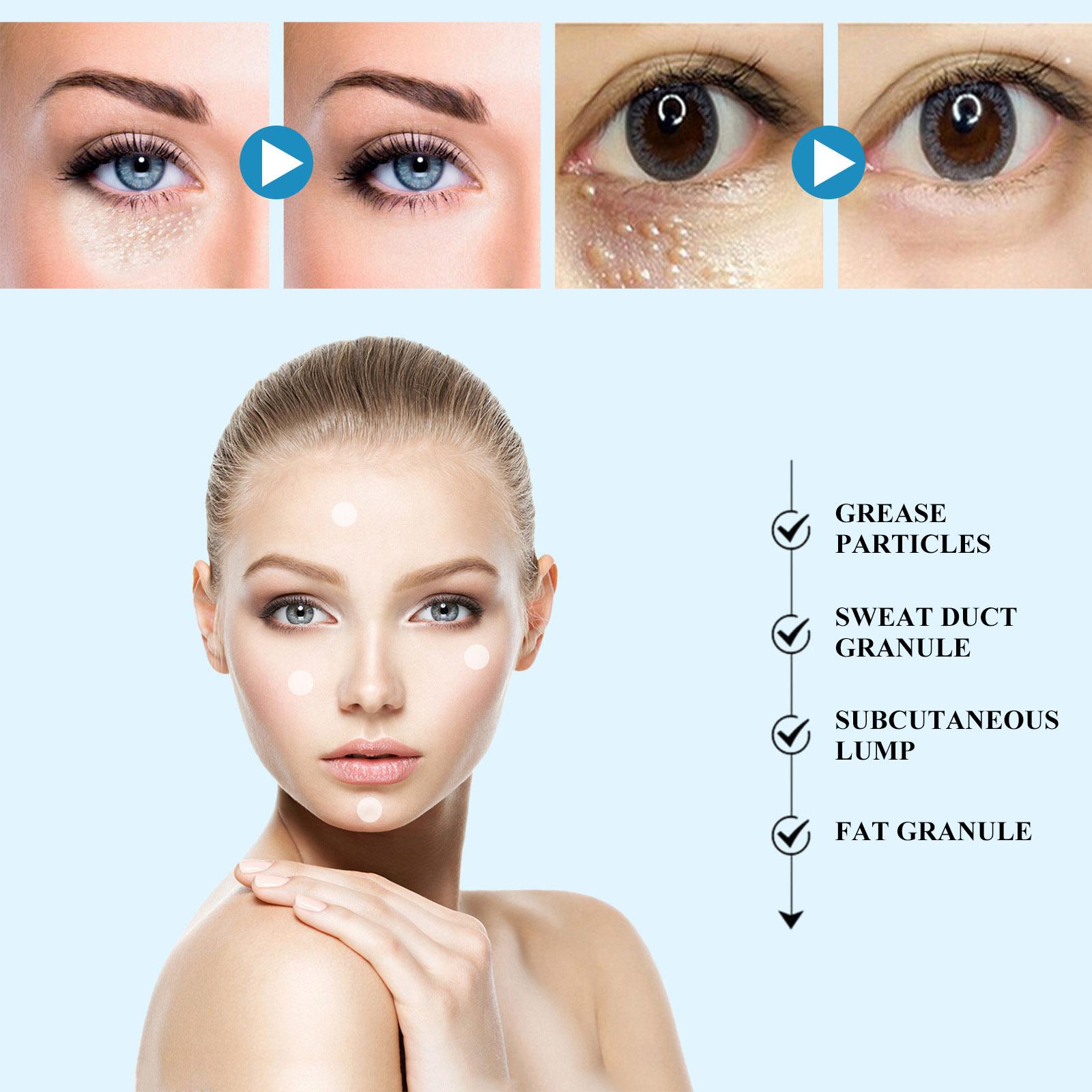 South Moon 144patch/Box Milia Remover Eye Cream Nourishing Moisturizing Repair Smoothing Eye Patches