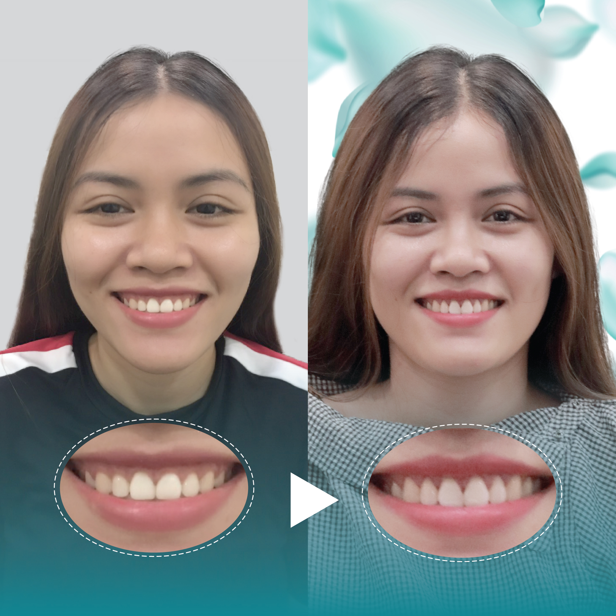 Điều trị dứt điểm hở lợi tại Nha Khoa Thẩm Mỹ Quốc Tế San Dentist