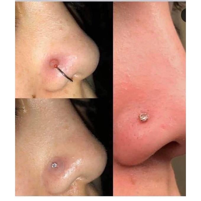 MIẾNG Nopull Disc / Miếng Nẹp Bump - Nẹp bump / Đệm siết