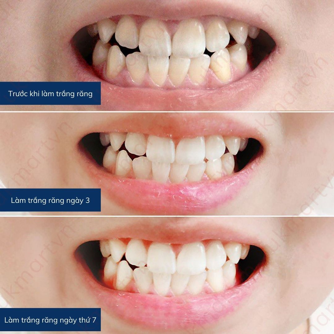 Kem Đánh Răng Hàn Quốc Trắng Răng MEDIAN DENTAL IQ 93% 120g