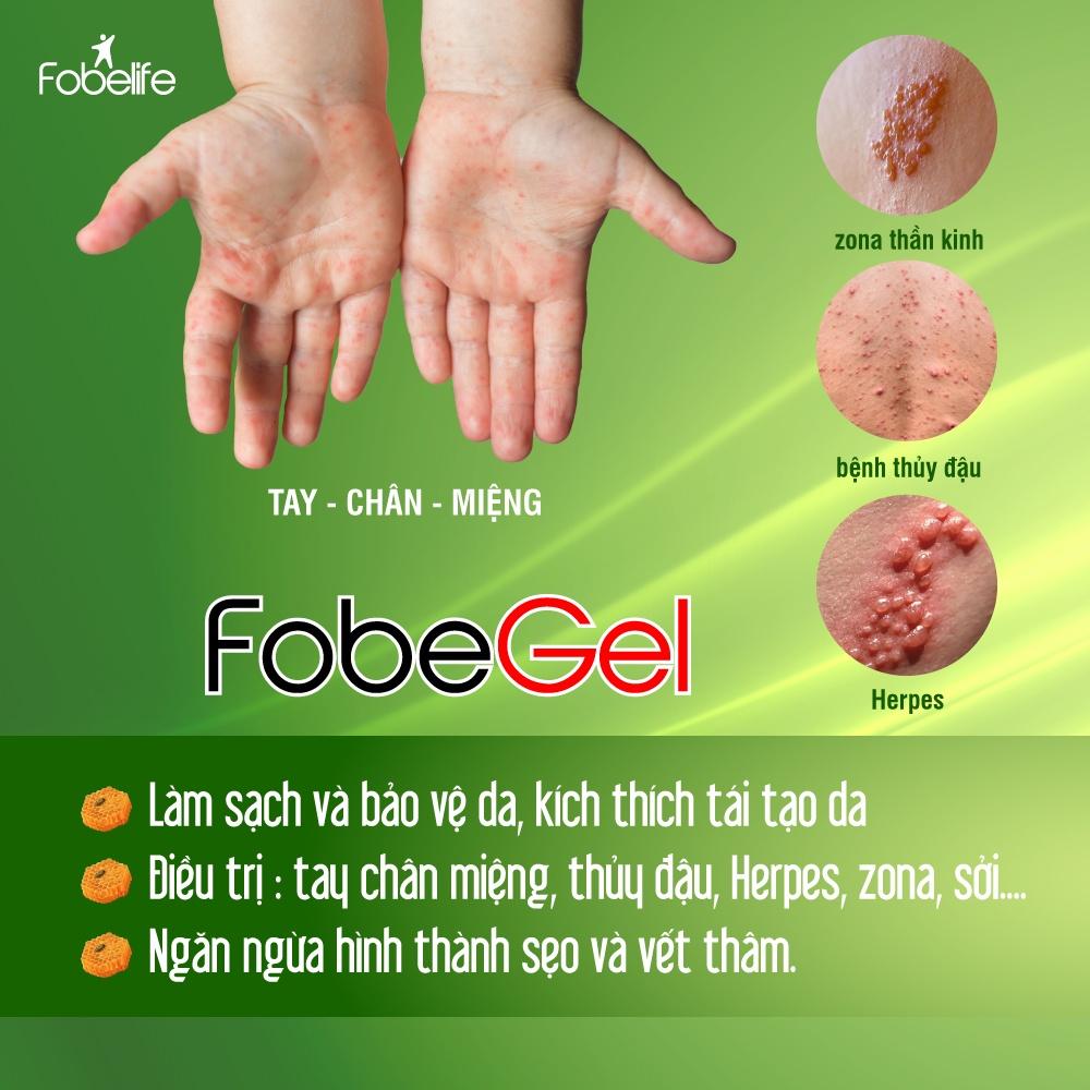 Gel Bôi Thủy Đậu Zona Làm Sạch Tái Tạo Da Fobe Gel Anti Virus