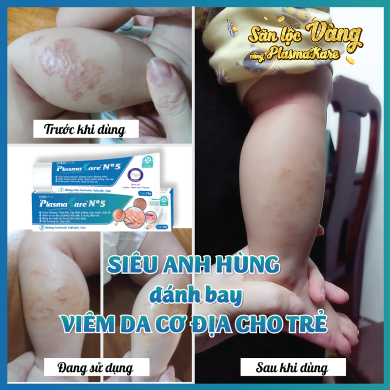 Kem bôi da Nano bạc cho viêm da cơ địa, viêm da tiếp xúc, muỗi và côn trùng đốt Plasmakare No5