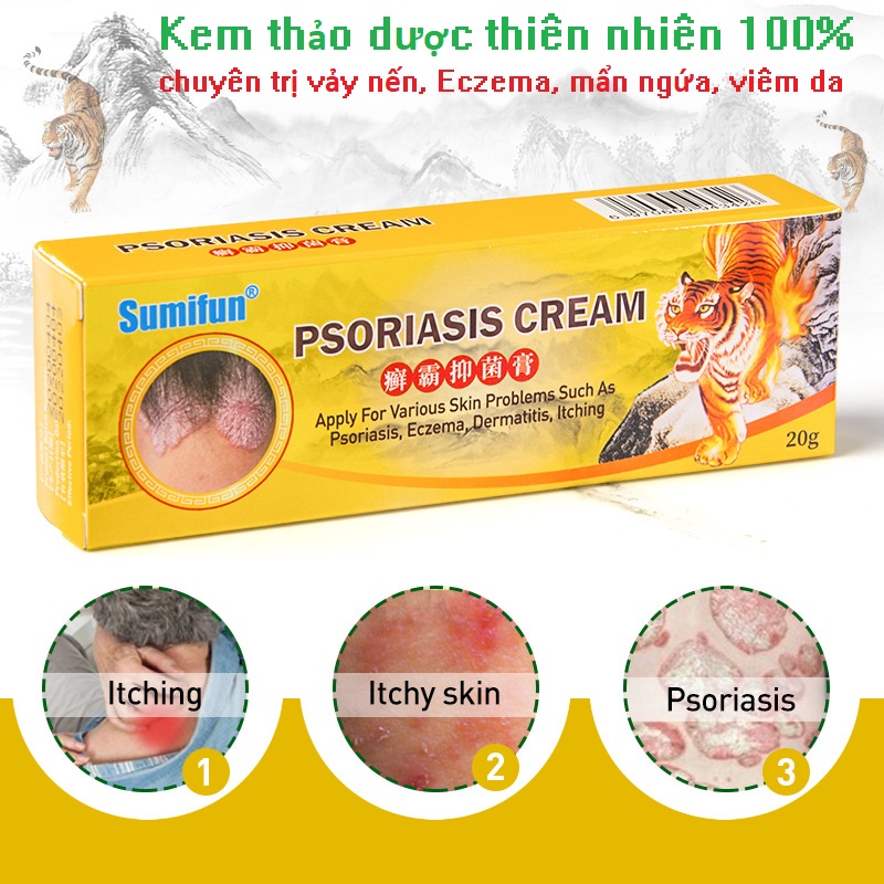 Kem hỗ trợ bôi vảy nến, ngứa do nấm, viêm da, tinh chất thảo dược thiên nhiên, tặng kèm vòng tay Luminous