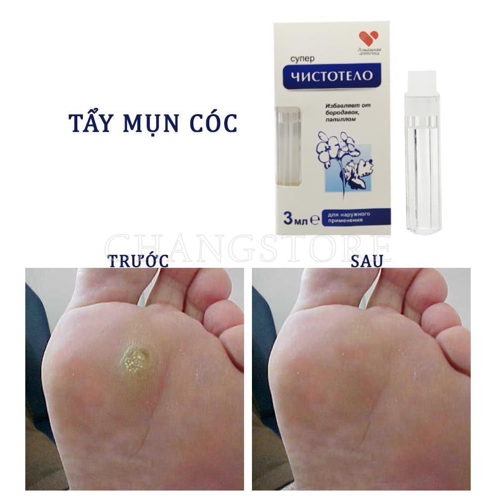 Gel tẩy nốt ruồi, mụn cóc, mụn thịt, tàn nhang, sẹo lồi Develinil của Nga