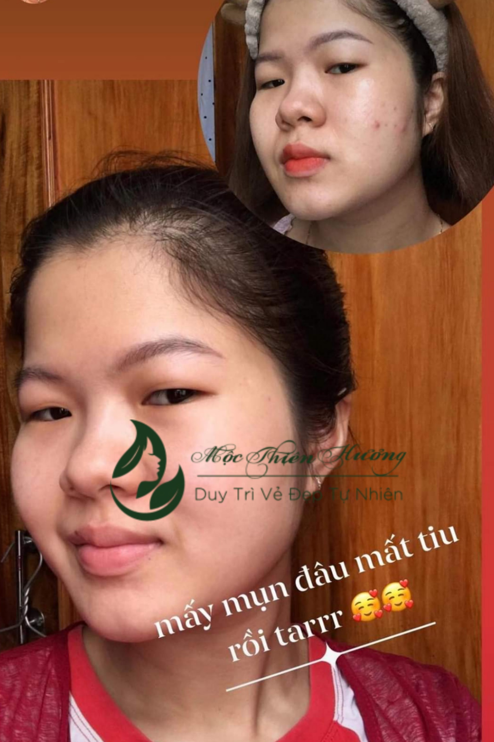 Serum 50ml Đánh Bay Mụn Thâm Nám Lâu Năm - Mộc Thiên Hương (Herbal Anti Acne Serum)