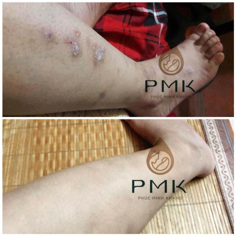 Tinh Chất Serum Mờ Thâm Minh Khang - Hết mọi loại thâm, an toàn, lành tính sử dụng mọi lứa tuổi