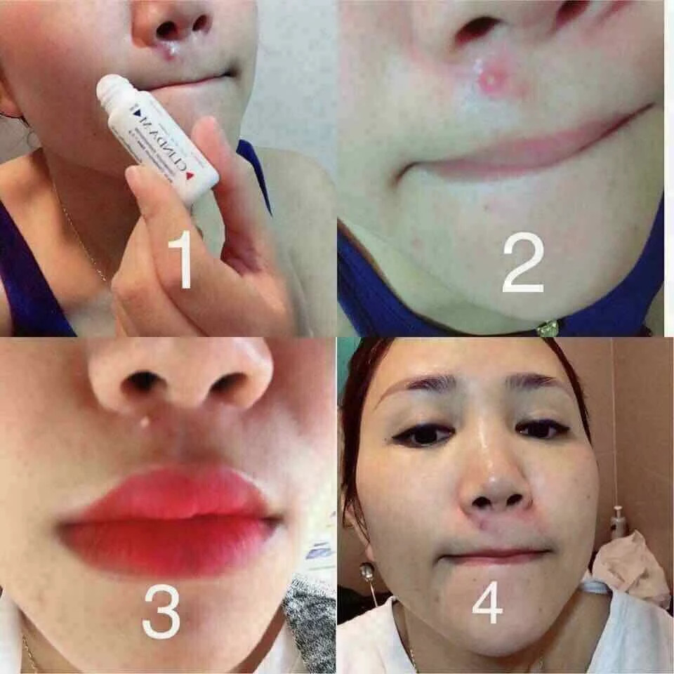 Gel mụn Clinda-M Thái Lan 15ml đẩy nhân mụn lên nhanh , giảm mụn