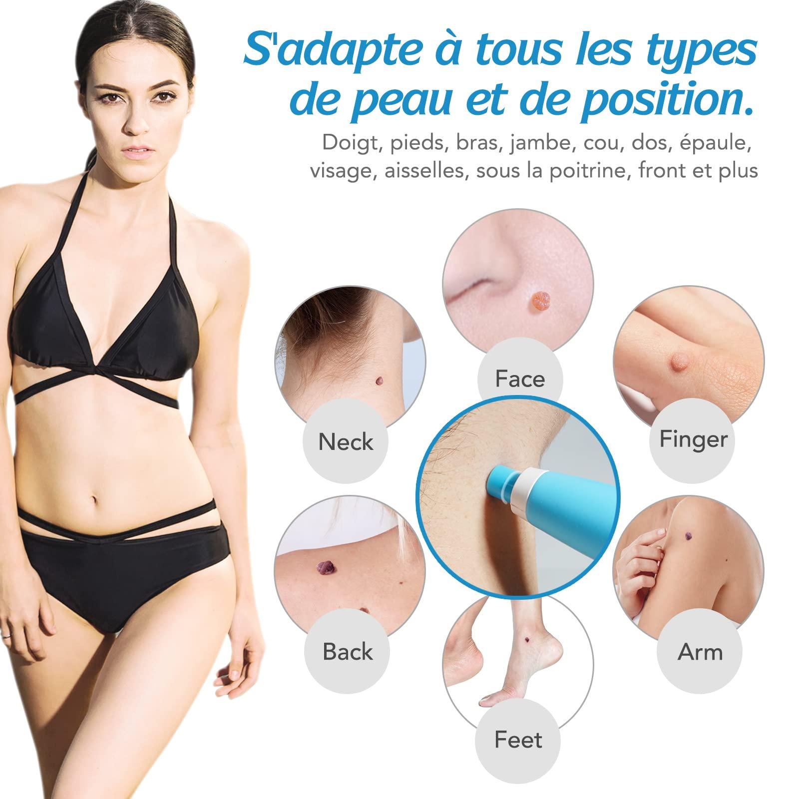 Bộ dụng cụ tẩy da Auto Skin,  bằng acrochordons,  da của mụn cóc 2-8mm, 2 trong 1 để  khỏi mặt, cơ thể mụn cóc, cơ thể mụn cóc