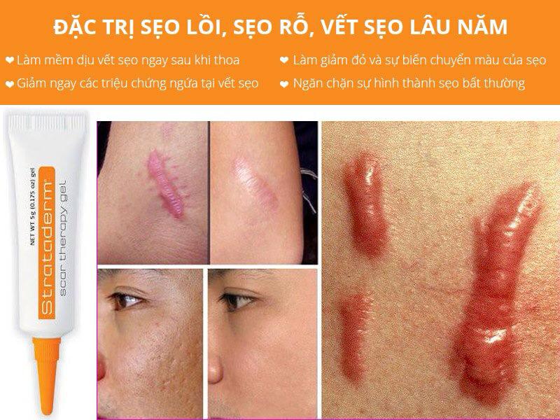 Kem Hỗ Trợ Cải Thiện Sẹo Lâu Năm, Sẹo Lồi Strataderm Thụy Sĩ