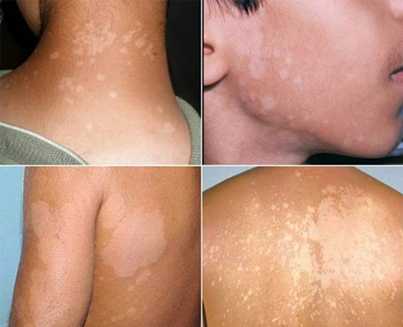 Thảo dược bôi nấm ngứa, tổ đỉa, hắc lào, lang ben, vảy nến, á sừng, zona các vấn đề về da_1 hộp 20 gói