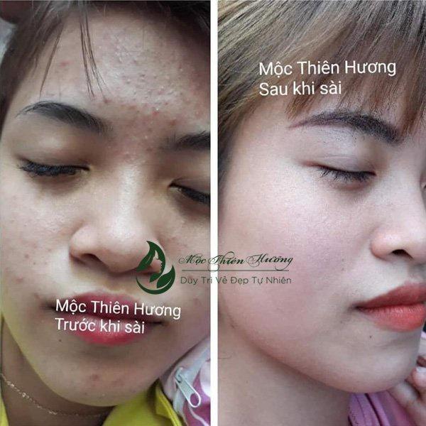 Serum Ngừa Mụn, Giảm Thâm, Dưỡng Sáng, Se Khít Da Từ Serum Thảo Mộc 100ml | Mộc Thiên Hương