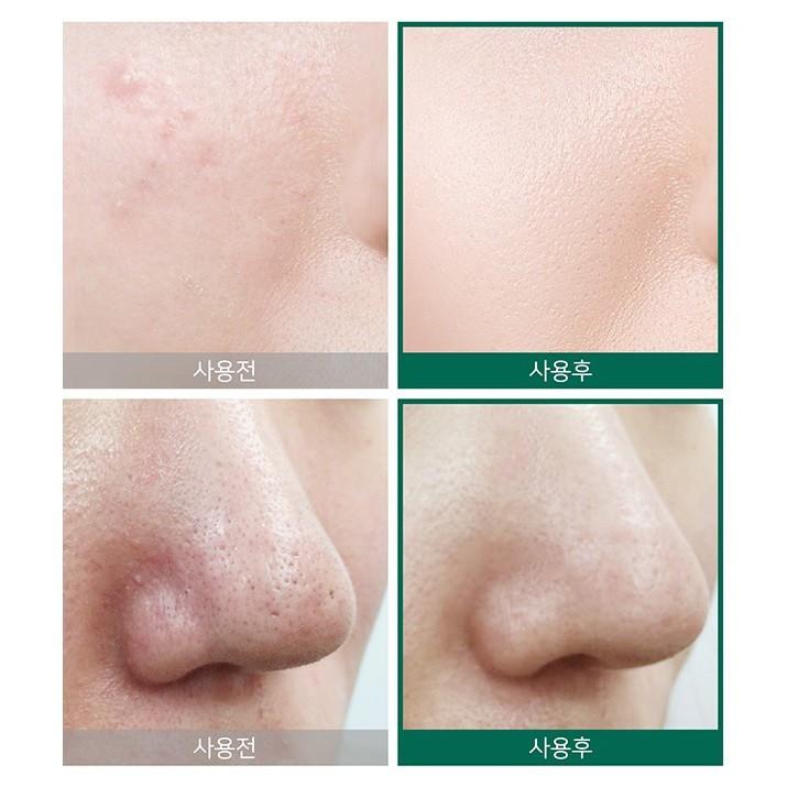 Combo Hỗ Trợ Giảm Mụn Some By Mi AHA-BHA-PHA 30 Days Miracle