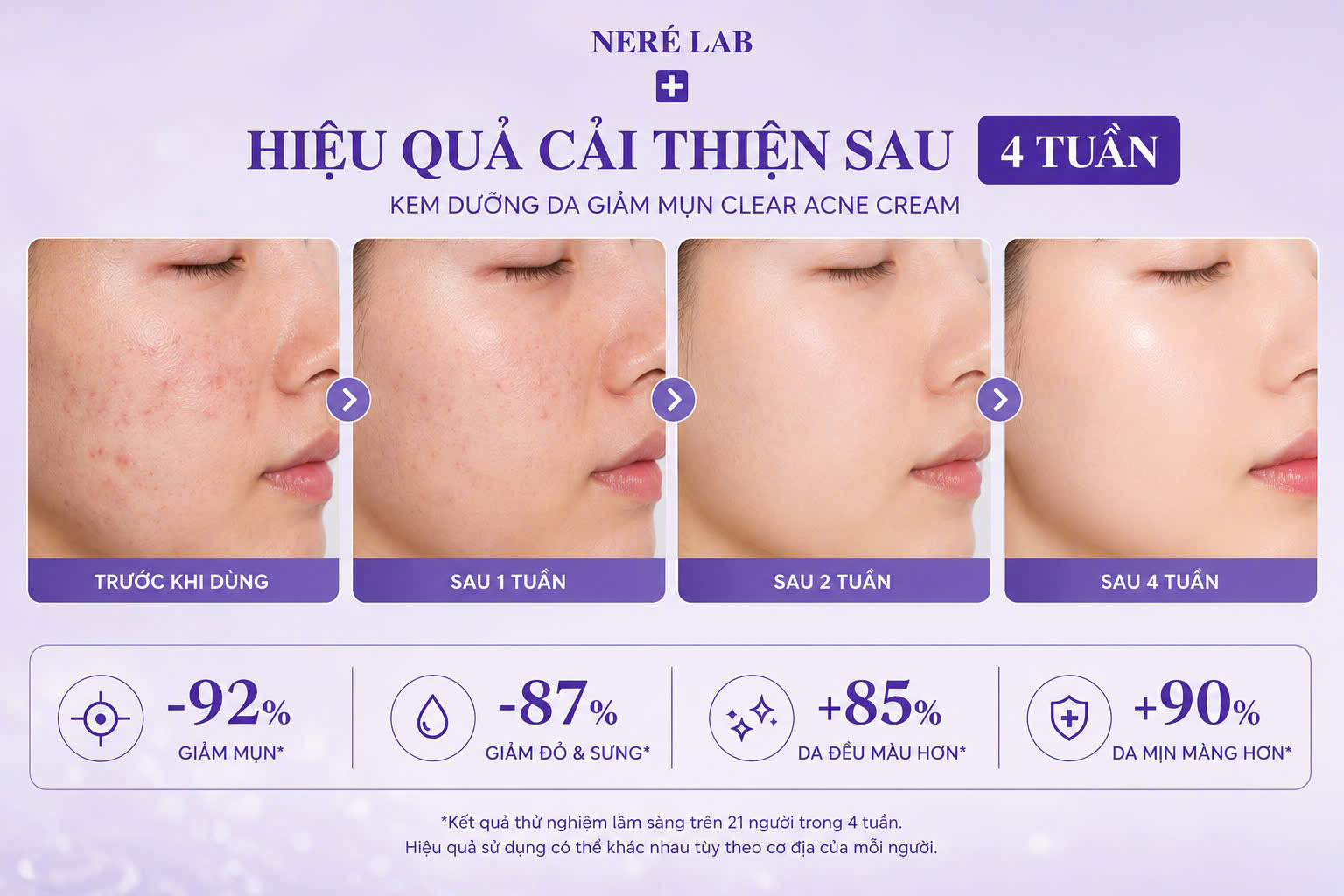 Kem Dưỡng Giảm Mụn Clear Acne 5g - Hỗ trợ giảm mụn, Làm sạch da, Giảm đỏ