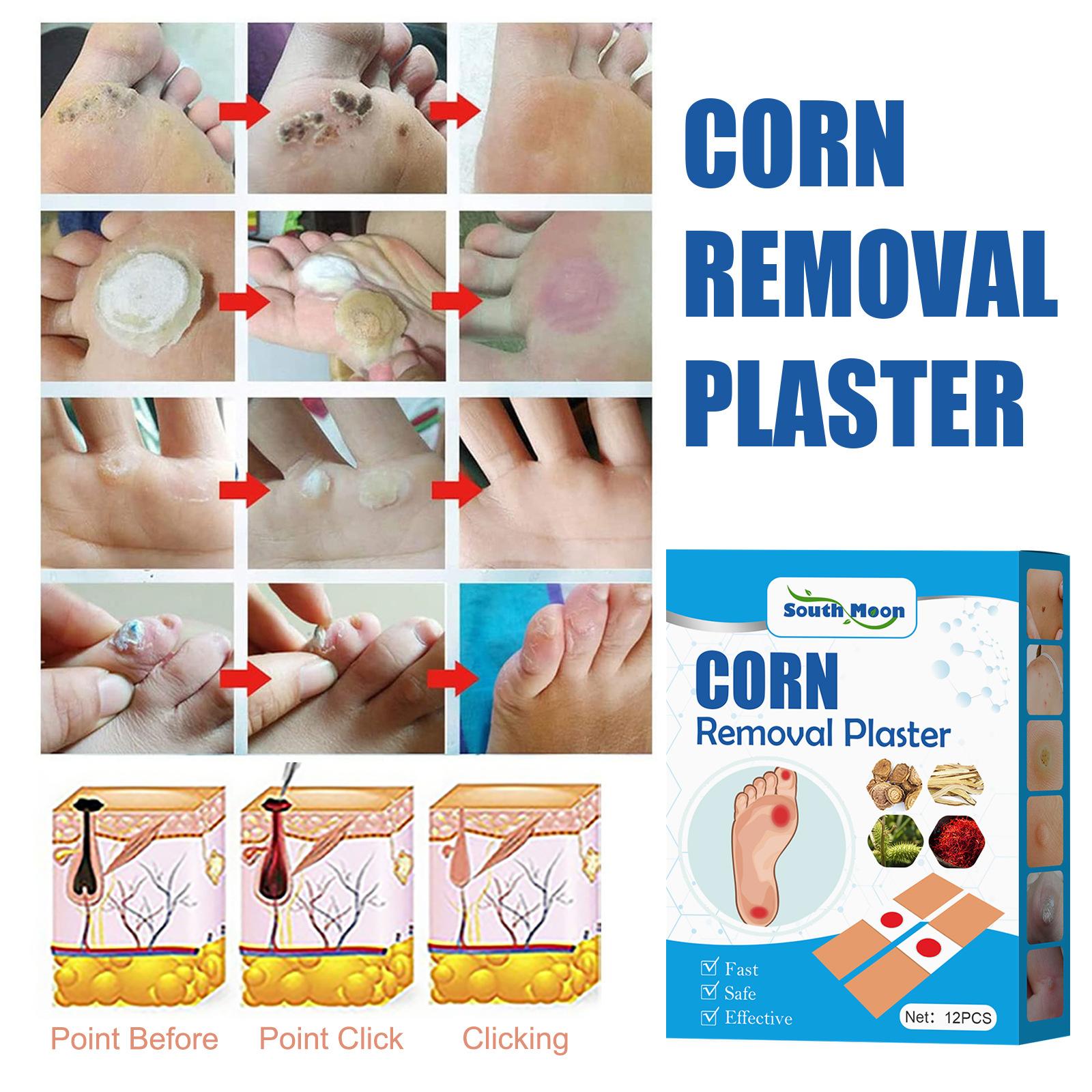 Mặt đường gà, tẩy da mụn cóc, chống lại mụn cóc, tẩy mắt gà, tẩy ngô, thạch cao bảo vệ áp lực để mụn cóc cứng đầu, ngô và giác mạc