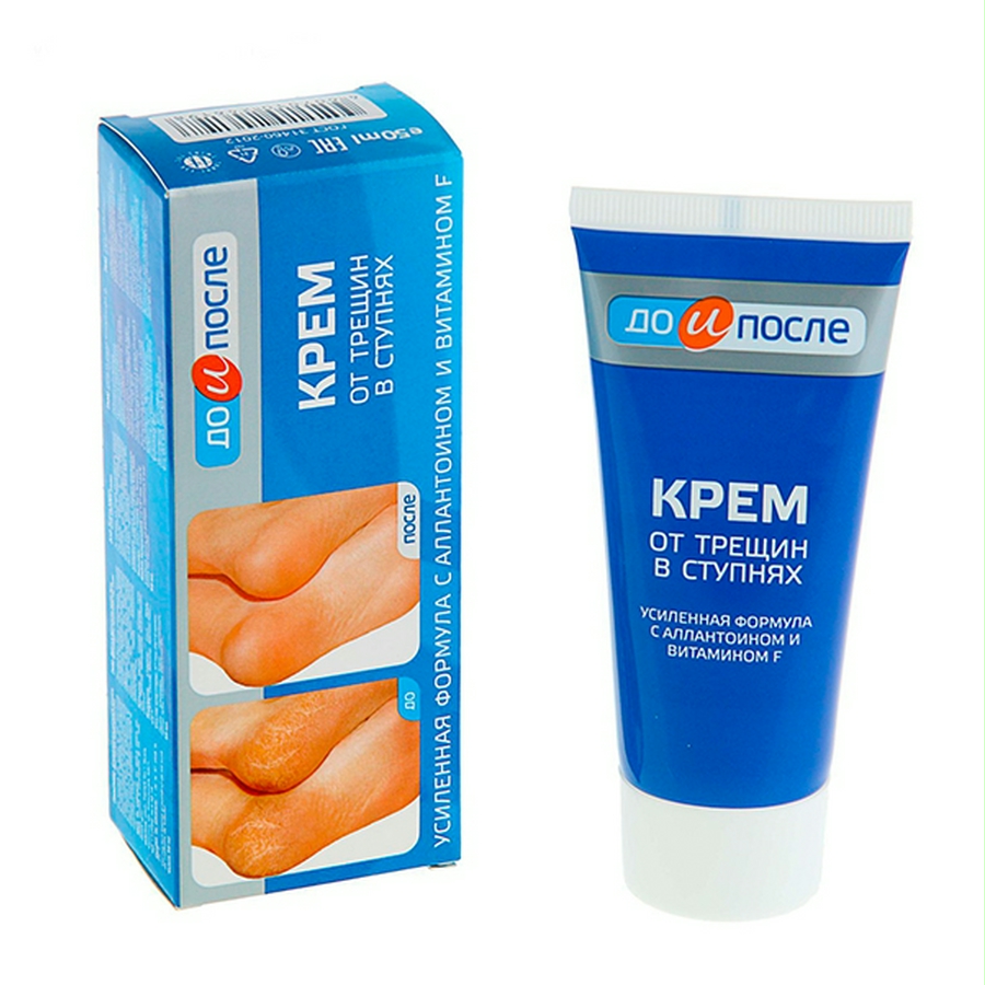 Kem dưỡng ngăn ngừa nứt gót chân Kpem Cream for Carcks in the feet 50ml