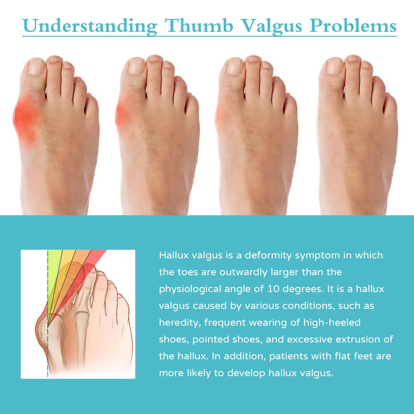 South Moon 8PCS Bunion Patch Relief Bunion Swelling Pain Patch Correction Foot Care Patch