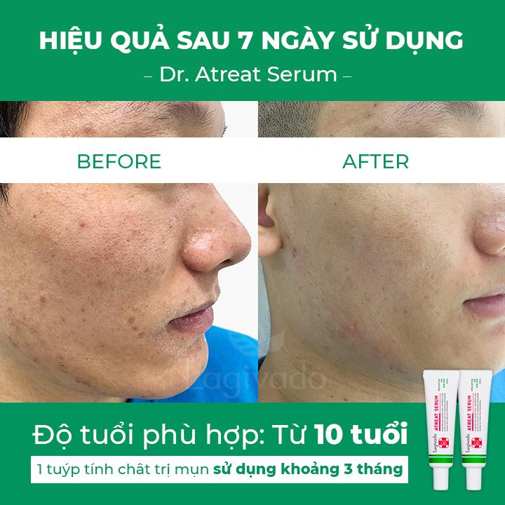 Bộ đôi serum giảm thâm, mờ sẹo mụn Hàn Quốc Lagivado  Dr. ATreat Serum 30 ml và sữa rửa mặt Creamy Foam 50ml