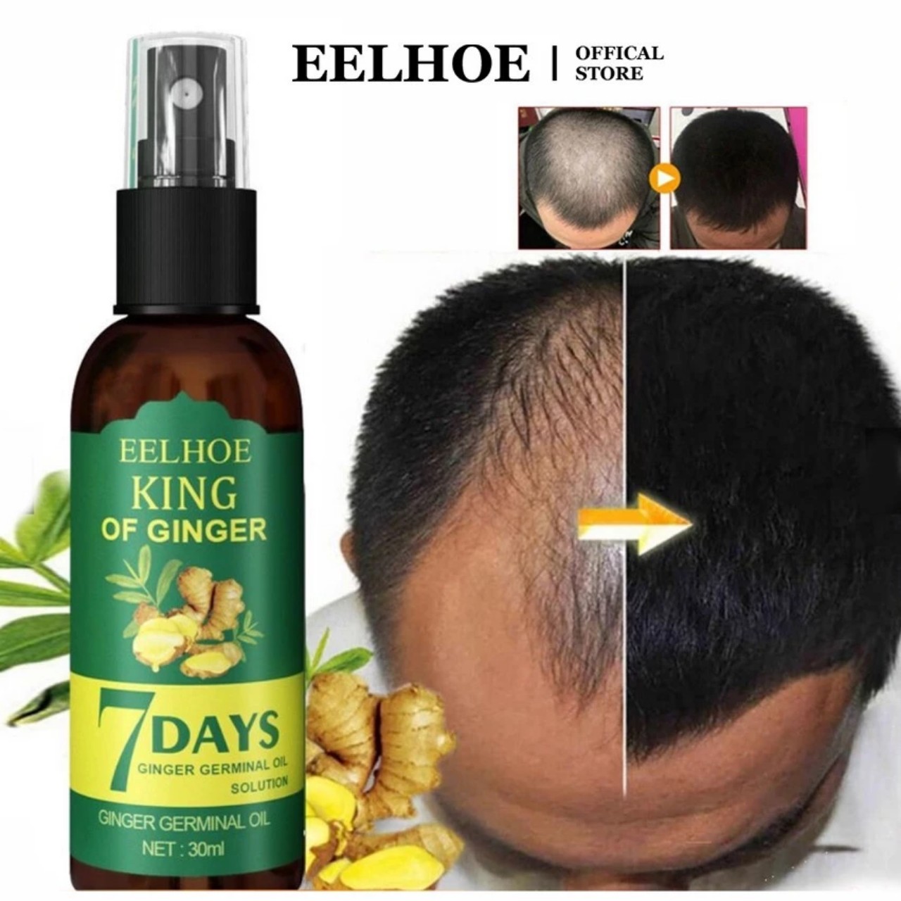 Mọc Tóc Mạnh Mẽ với Tinh Dầu Xịt ELHOE: Tinh Chất Nhân Sâm và Gừng Tươi Hiêu Qủa Sau 7 Ngày