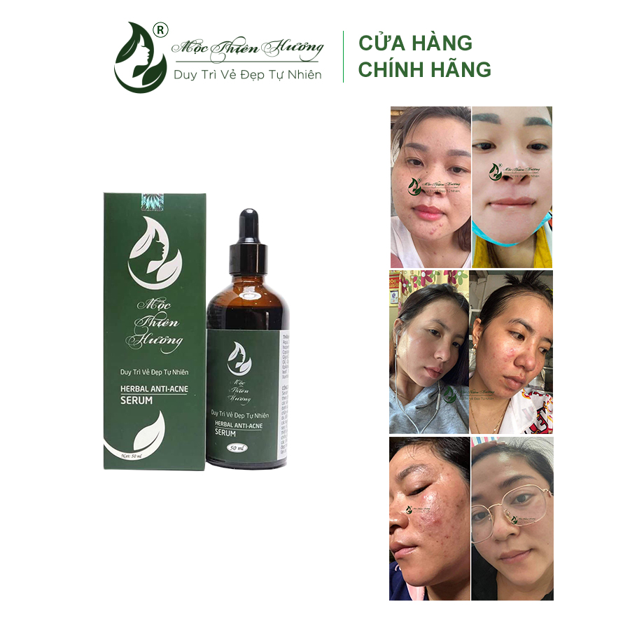 Serum 50ml Đánh Bay Mụn Thâm Nám Lâu Năm - Mộc Thiên Hương (Herbal Anti Acne Serum)