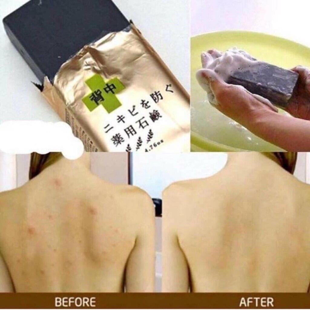 XÀ PHÒNG TẮM NGỪA MỤN VÙNG LƯNG FOR BACK 135G - NỘI ĐỊA NHẬT BẢN