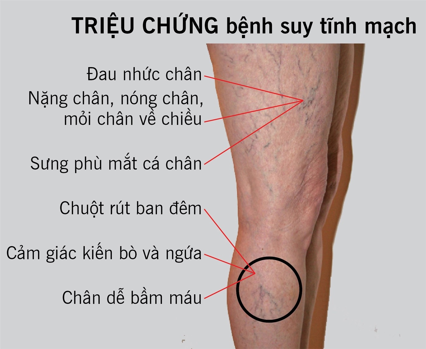 Kem hỗ trợ suy giãn tĩnh mạch do công việc đứng lâu và nhiều, thành phần thảo dược, an toàn và chi phí cực rẻ