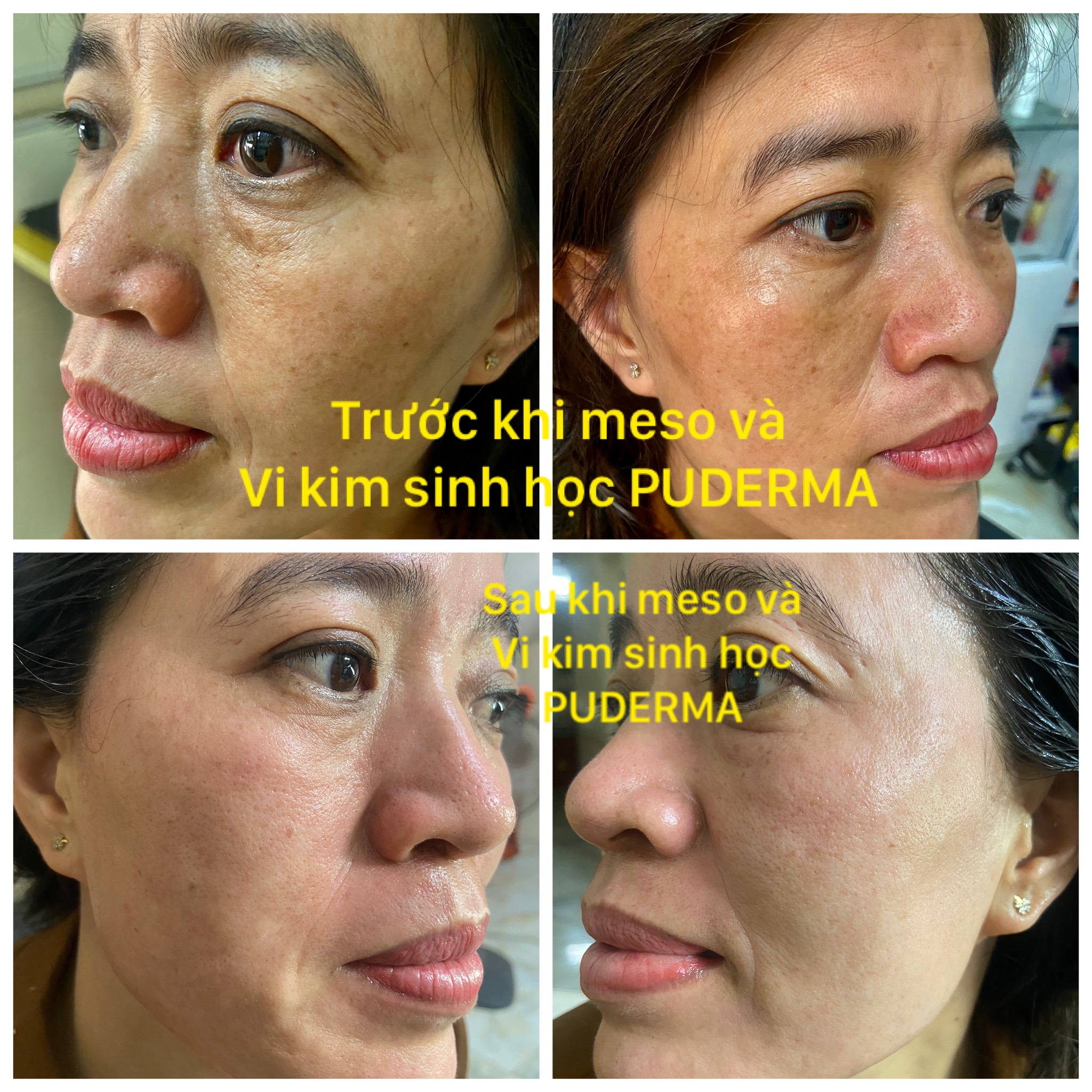 Kem Vi Kim Sinh Học Puderma: Tái tạo da, phá Nám không xâm lấn, không xưng đỏ, hiệu quả sau 3 ngày.