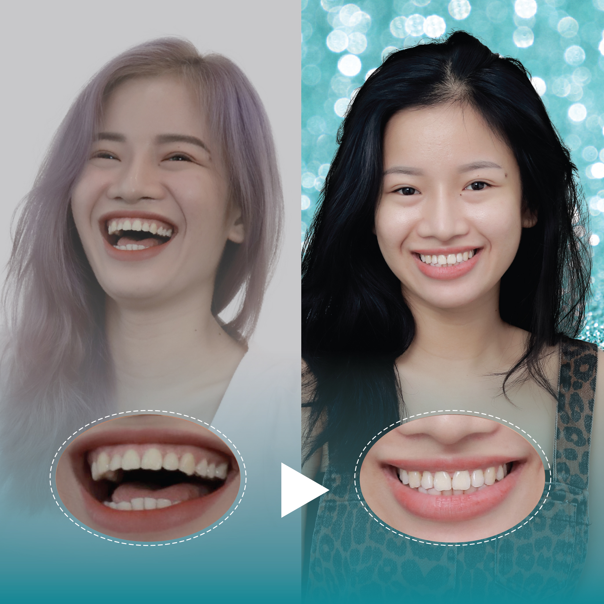 Điều trị dứt điểm hở lợi tại Nha Khoa Thẩm Mỹ Quốc Tế San Dentist