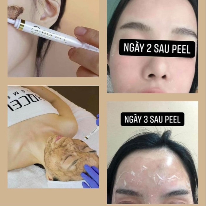 Set Liệu Trình Thay Da Sinh Học Bqcell Derma Skin Peeling Hàn Quốc