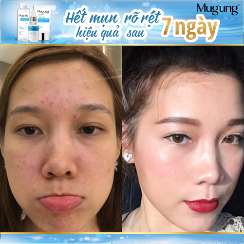 Serum Mugung Acne Treatment sạch mụn,giảm mụn bọc kích thích mụn đầu đen,mụn ẩn, mụn sưng, mụn mủ, mụn li ti mẫn đỏ, thâm mẫu mới