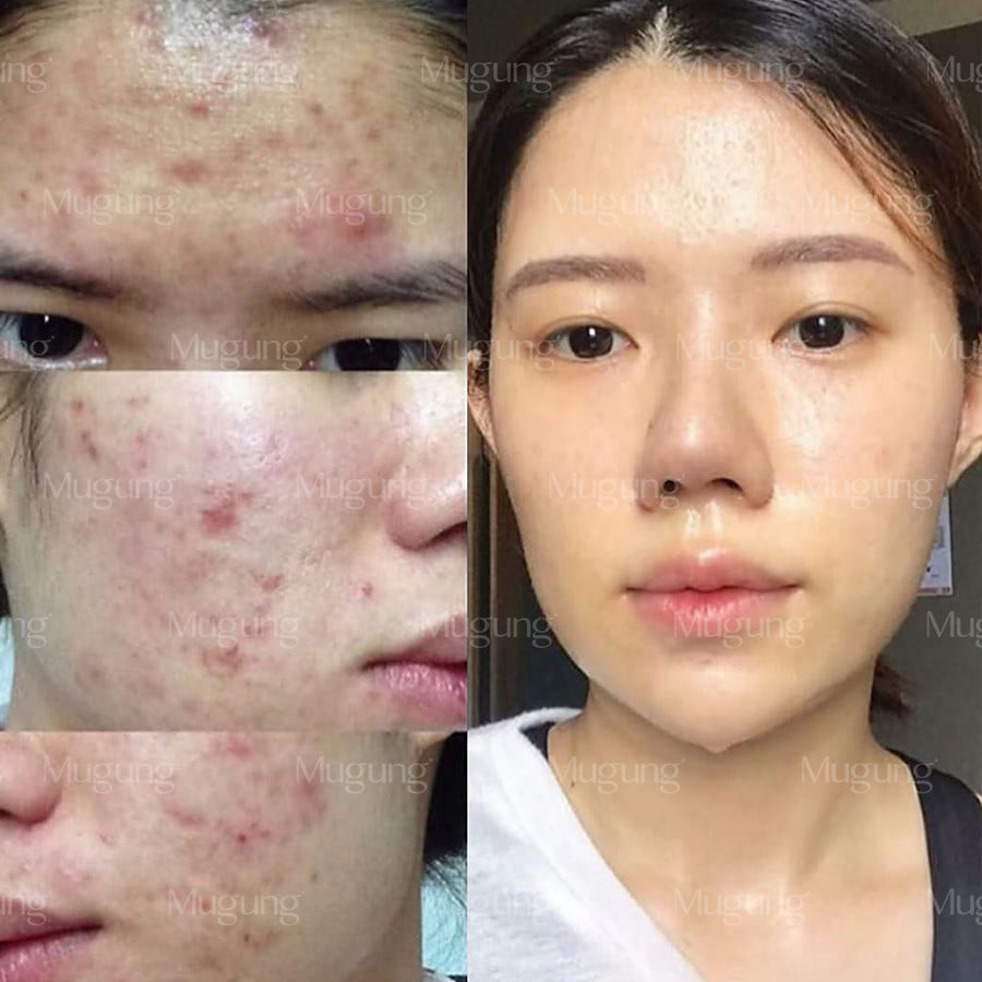 Serum giảm mụn Mugung 7 ngày hiệu quả giảm mụn đầu đen,mụn bọc (Làm xẹp không bong da) Acne Treatment 15ml