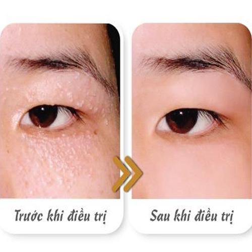 TMV SAIGON BEAUTY - ĐỐT NỐT RUỒI, MỤN THỊT AN TOÀN KHÔNG ĐỂ LẠI SẸO