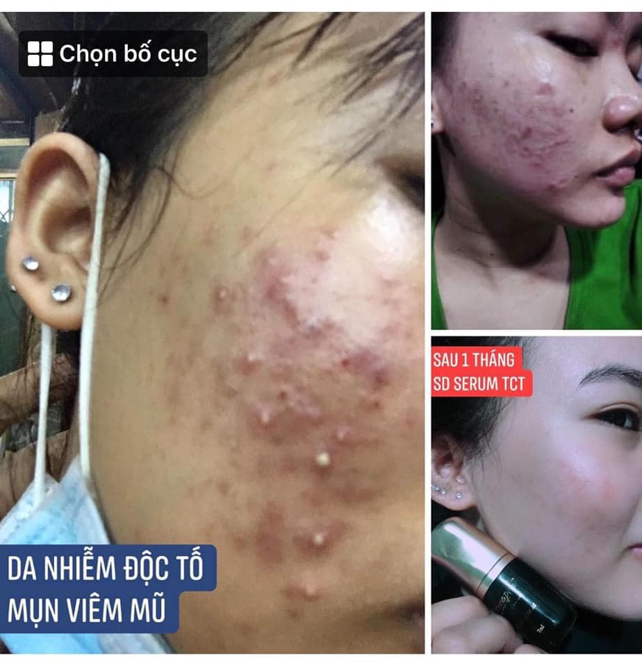 Serum trứng cá tuyết Dermapeel - sạch mụn - mờ thâm - da căng bóng trắng sáng sau 14 ngày