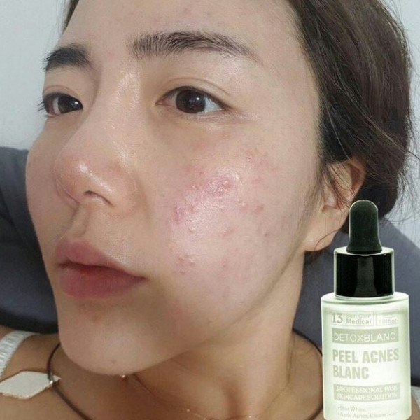 Peel Lộc Đề Ngừa Mụn Trắng Da Peel Acnes Blanc Thương Hiệu Detox Blanc (Pháp) – Giúp Ngừa Mụn, Giảm Mụn Và Làm Trắng Da Hiệu Quả - Tặng Kèm Khẩu Trang Chống Nắng