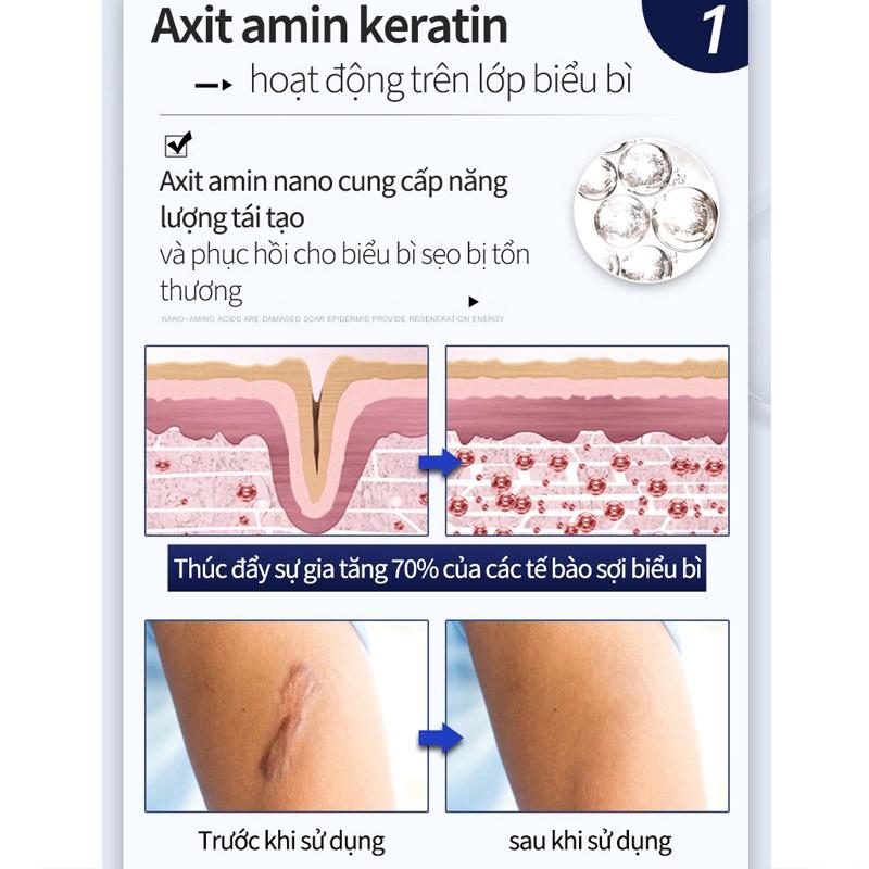 (Giá tốt) Kem bôi xóa mờ sẹo lồi lõm lâu năm , rạn da sau sinh, vết thâm do mụn cải thiện hiệu quả giúp da láng mịn