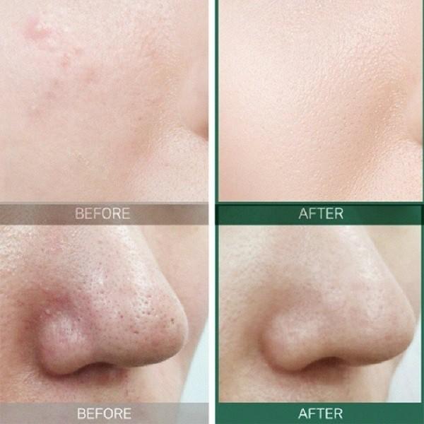 Bộ 4 SP Dưỡng Da Ngừa Mụn Some By Mi AHA-BHA-PHA 30Days Miracle