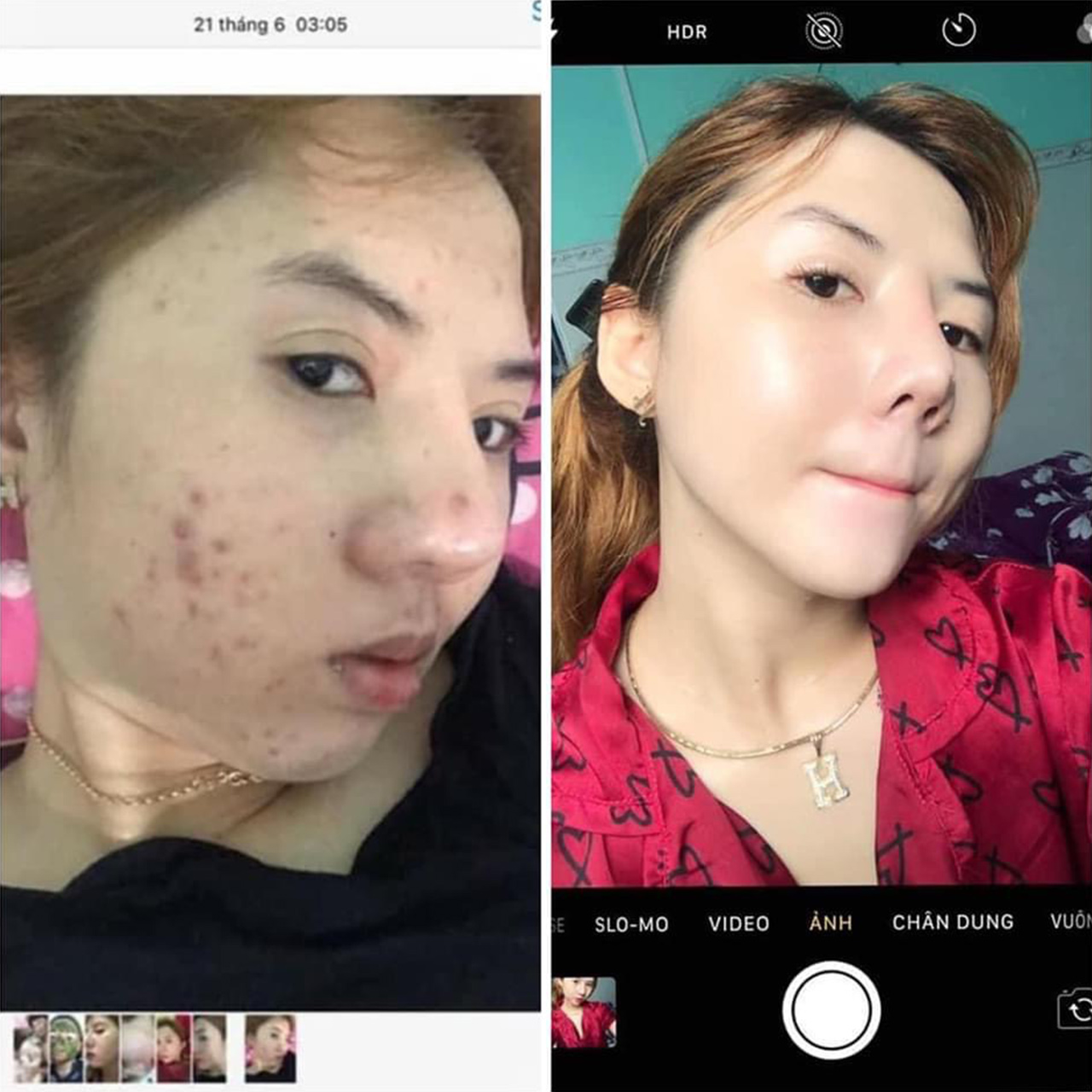 ANTI ACNE FOR GIRL Serum hỗ trợ điều trị mụn