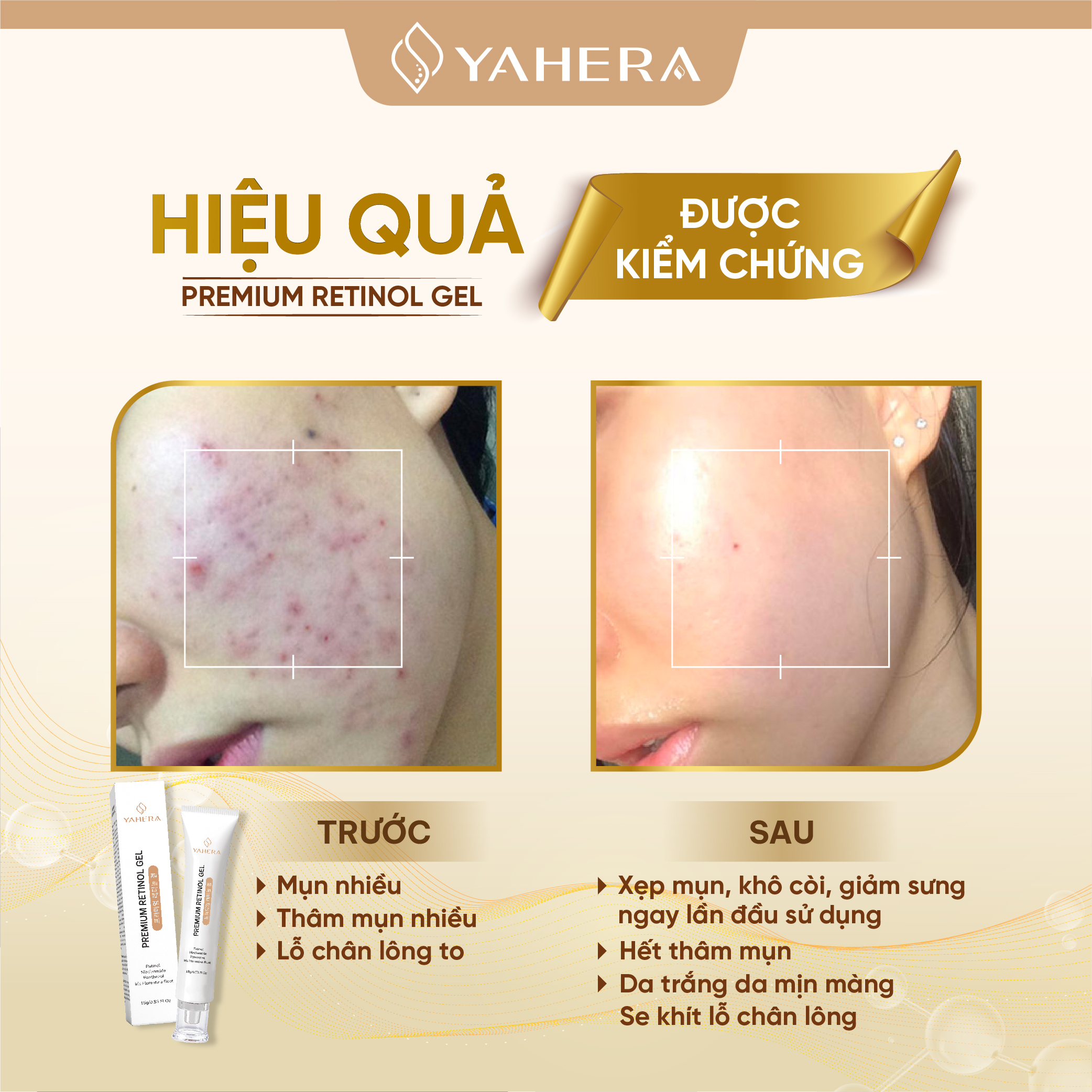 Gel chấm mụn cao cấp YAHERA Premium Retinol Gel giúp giảm sưng viêm khô cồi xệp mụn 15G