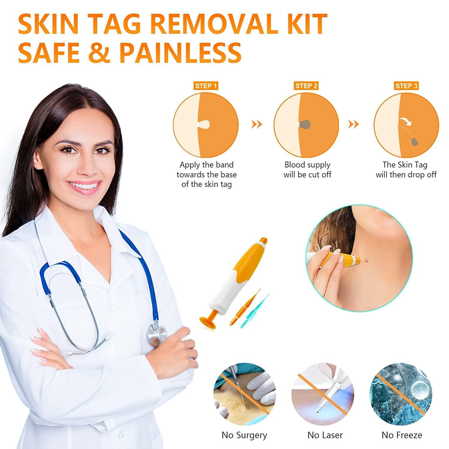 Remover Kit, mụn cóc bằng mụn cóc.