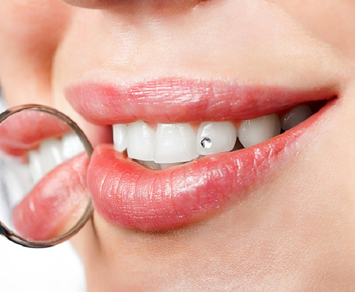 Đính Đá Răng Thẩm Mỹ - Nha Khoa Gia Hân