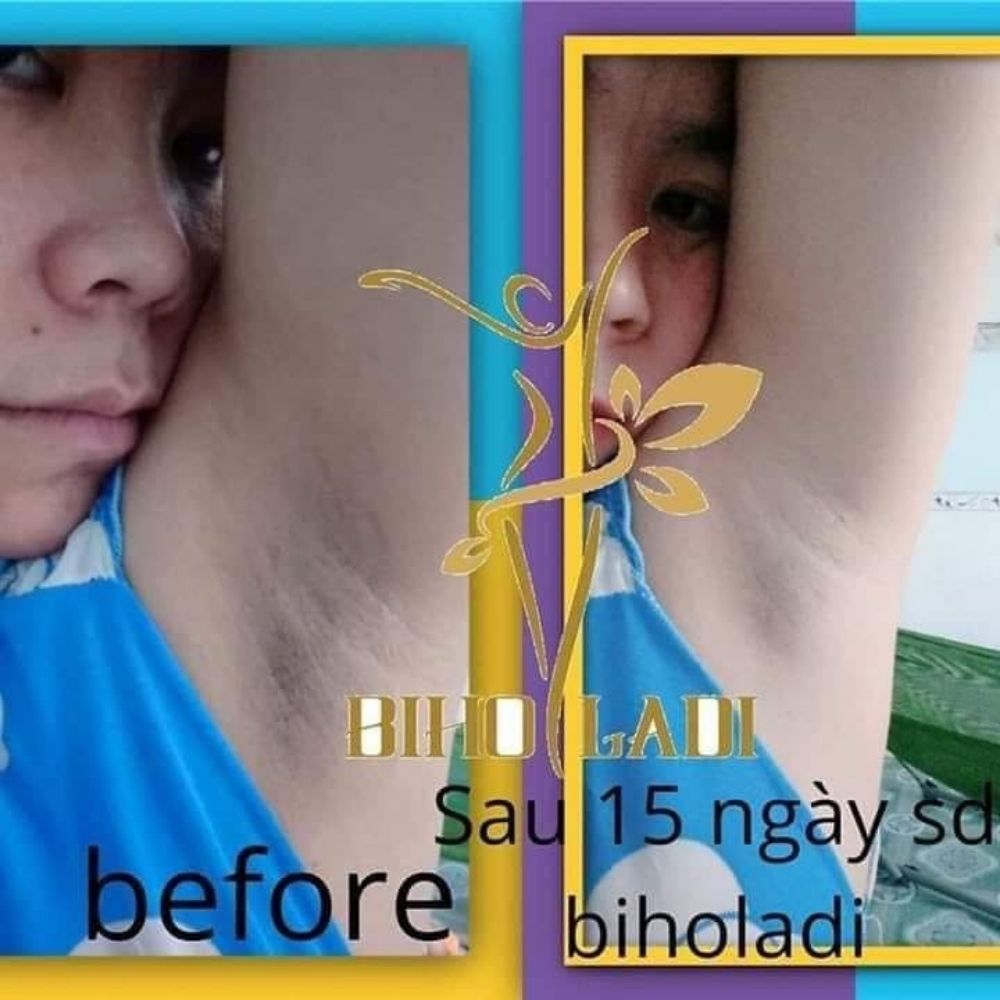 [CHÍNH HÃNG] SIÊU DƯỠNG THÂM 5S BIHO LADI - ĐÁNH BAY MỌI VẾT THÂM NÁCH, BẸN, THÂM MÔNG, BIKINI, BỤNG, ĐẦU GỐI, CÙI CHỎ