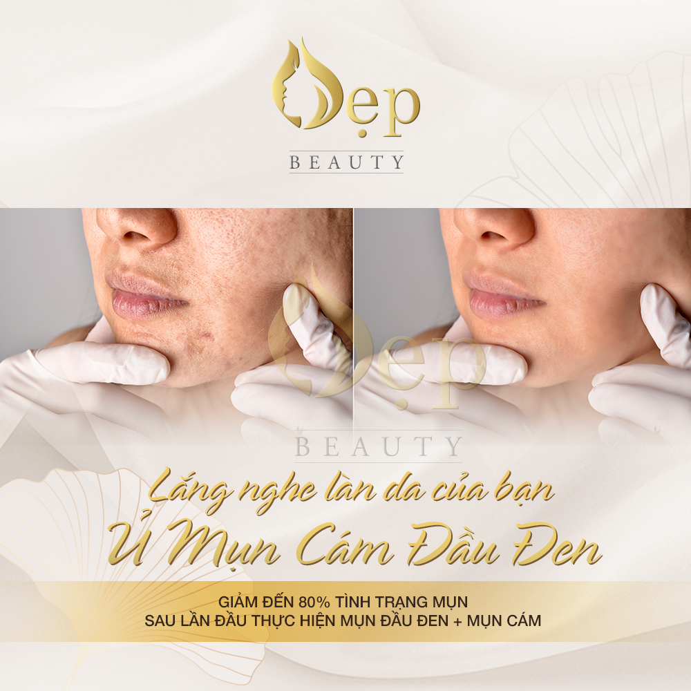 Ủ Mụn Cám Đầu Đen tại Đẹp Beauty Spa