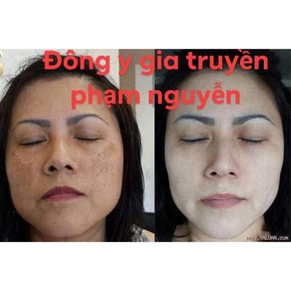 Bộ kem dưỡng trăng, giảm nám tàn nhang và serum cốt sâm đông y gia truyền phạm nguyễn