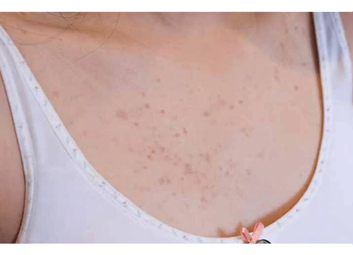 Thảo dược bôi nấm ngứa, tổ đỉa, hắc lào, lang ben, vảy nến, á sừng, zona các vấn đề về da_1 hộp 20 gói