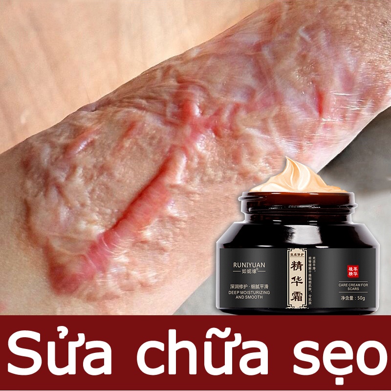 Kem xoá mờ sẹo 50g xóa sẹo thâm lồi, lõm, bỏng, thủy đậu, rạn da sau sinh , vết thâm mặt cải thiện làn da sáng mịn