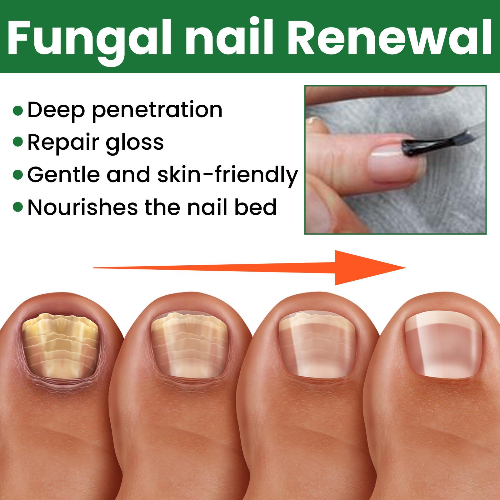 EELHOE 30ml Nail Treatment Essence for Onychomycosis Mild Non-irritating Nail Bright Shiny Repair Nail Repair Solution